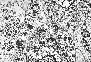 M, 38y. | granular cell tumor